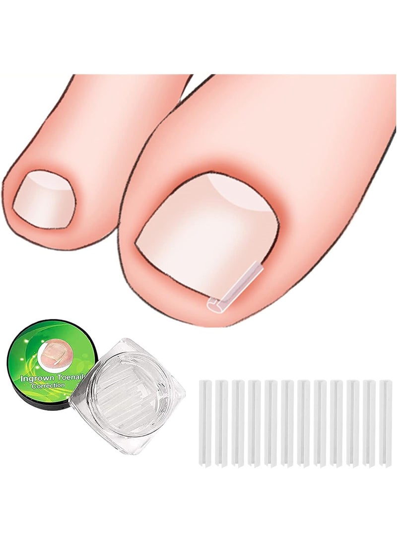 مجموعة تقويم الأسنان لأظافر القدم الداخلية ، بما في ذلك 30 بقعة تصحيح أظافر القدم الداخلية ، ومعدات حماية تصحيح أظافر القدم ، وأدوات إصلاح القدم ، ورفعات وملفات أظافر القدم الداخلية - Image 3